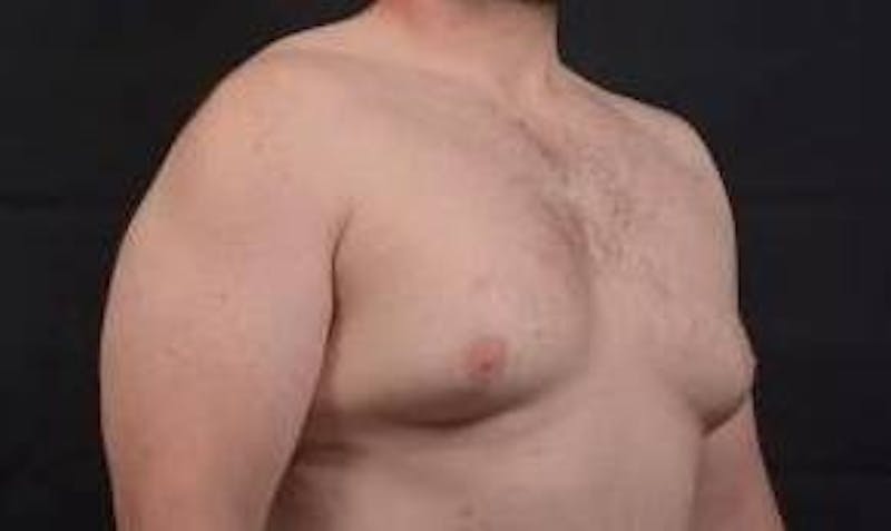Gynecomastia Before & After Gallery - Patient 153510 - Image 9
