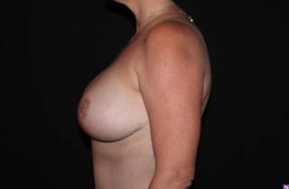 Breast Reduction Before & After Gallery - Patient 158440 - Image 6