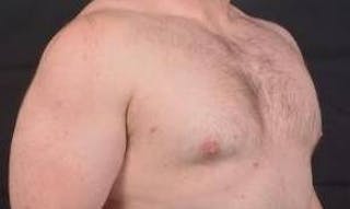 Gynecomastia Before & After Gallery - Patient 153510 - Image 10