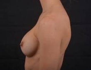 Aesthetic Breast Revision Before & After Gallery - Patient 259596 - Image 4