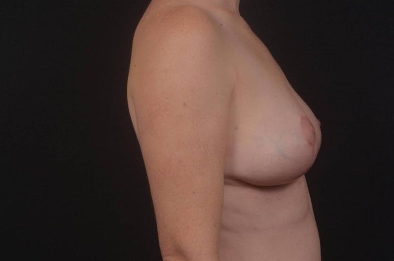 Mastopexy Before & After Gallery - Patient 371495 - Image 6