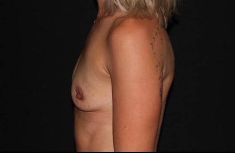 Breast Augmentation Silicone Gel Before & After Gallery - Patient 191707 - Image 5