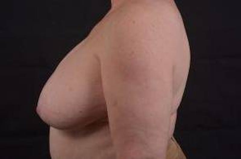 Breast Reduction Before & After Gallery - Patient 161821 - Image 3