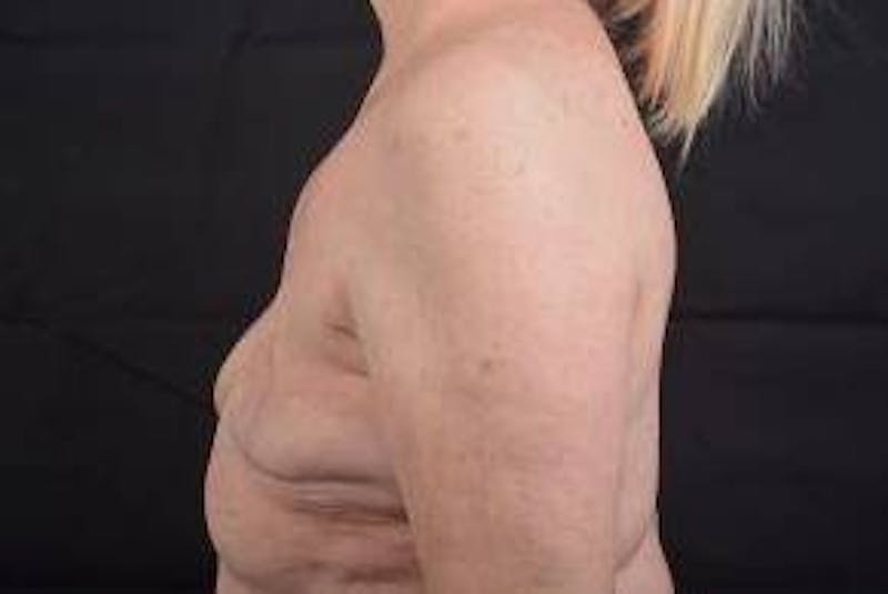 Delayed Breast Reconstruction Before & After Gallery - Patient 108170 - Image 3