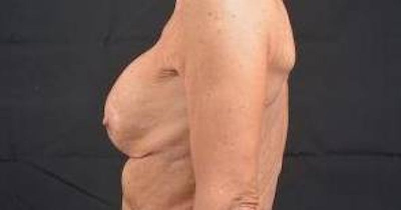 Aesthetic Breast Revision Before & After Gallery - Patient 334923 - Image 3