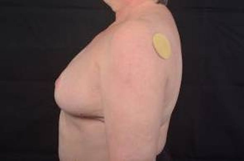 Breast Reduction Before & After Gallery - Patient 161821 - Image 4