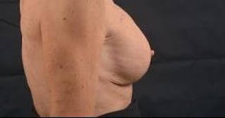 Aesthetic Breast Revision Before & After Gallery - Patient 334923 - Image 4