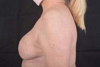 Delayed Breast Reconstruction Before & After Gallery - Patient 108170 - Image 4
