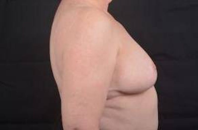 Breast Reduction Before & After Gallery - Patient 161821 - Image 6