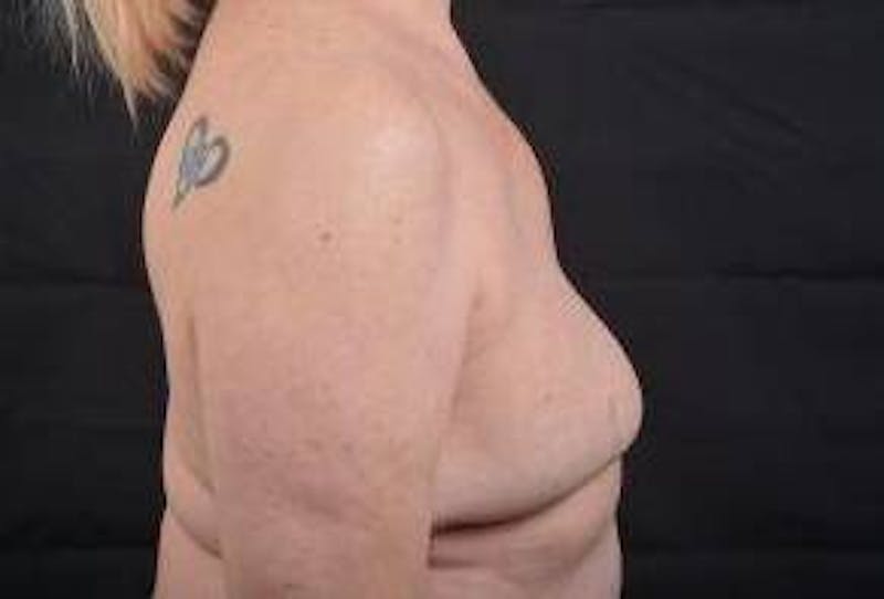 Delayed Breast Reconstruction Before & After Gallery - Patient 108170 - Image 5