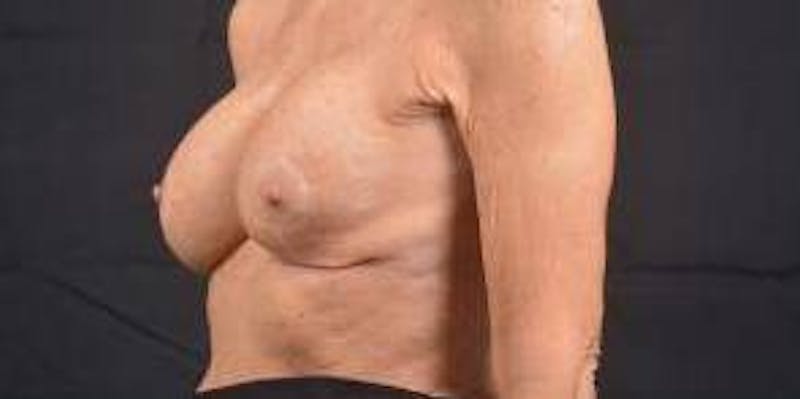 Aesthetic Breast Revision Before & After Gallery - Patient 334923 - Image 5