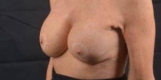 Aesthetic Breast Revision Before & After Gallery - Patient 334923 - Image 6