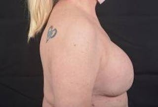 Delayed Breast Reconstruction Before & After Gallery - Patient 108170 - Image 6