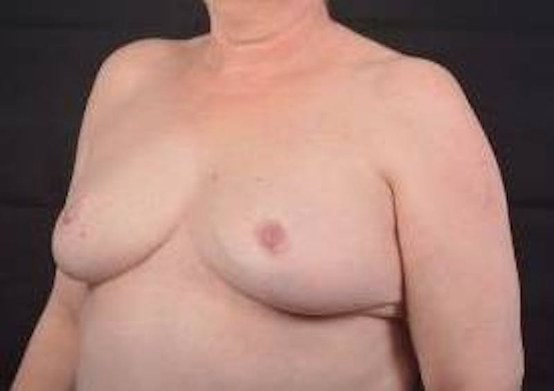 Breast Reduction Before & After Gallery - Patient 161821 - Image 8