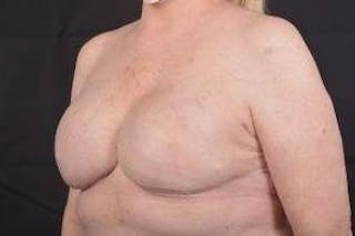 Delayed Breast Reconstruction Before & After Gallery - Patient 108170 - Image 8