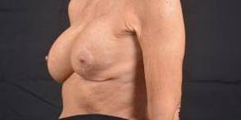 Aesthetic Breast Revision Before & After Gallery - Patient 334923 - Image 7