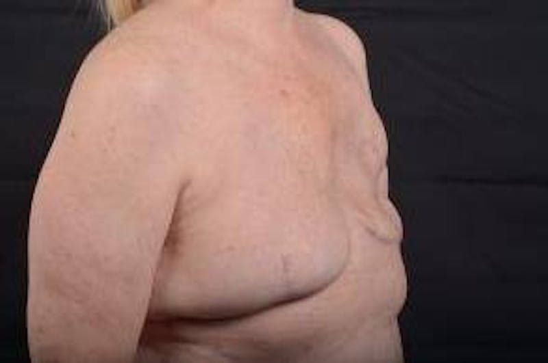 Delayed Breast Reconstruction Before & After Gallery - Patient 108170 - Image 9