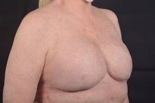 Delayed Breast Reconstruction Before & After Gallery - Patient 108170 - Image 10