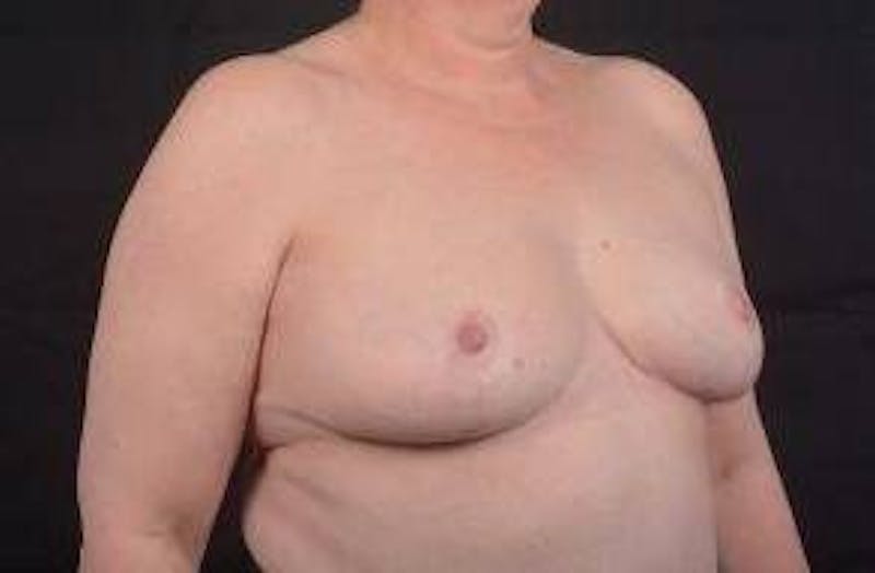 Breast Reduction Before & After Gallery - Patient 161821 - Image 10