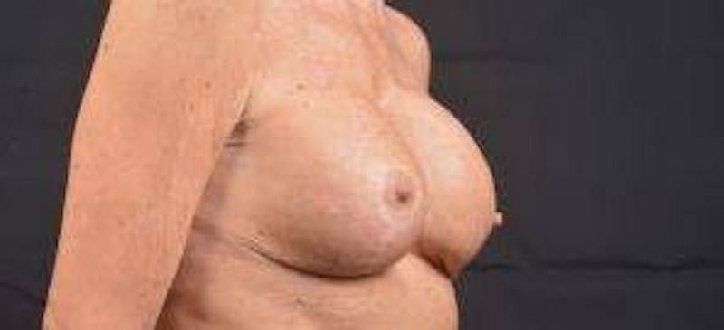 Aesthetic Breast Revision Before & After Gallery - Patient 334923 - Image 9