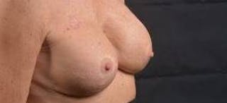 Aesthetic Breast Revision Before & After Gallery - Patient 334923 - Image 10