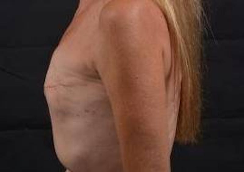 Delayed Breast Reconstruction Before & After Gallery - Patient 320892 - Image 3