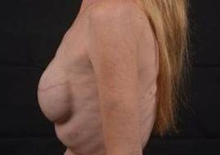 Delayed Breast Reconstruction Before & After Gallery - Patient 320892 - Image 4