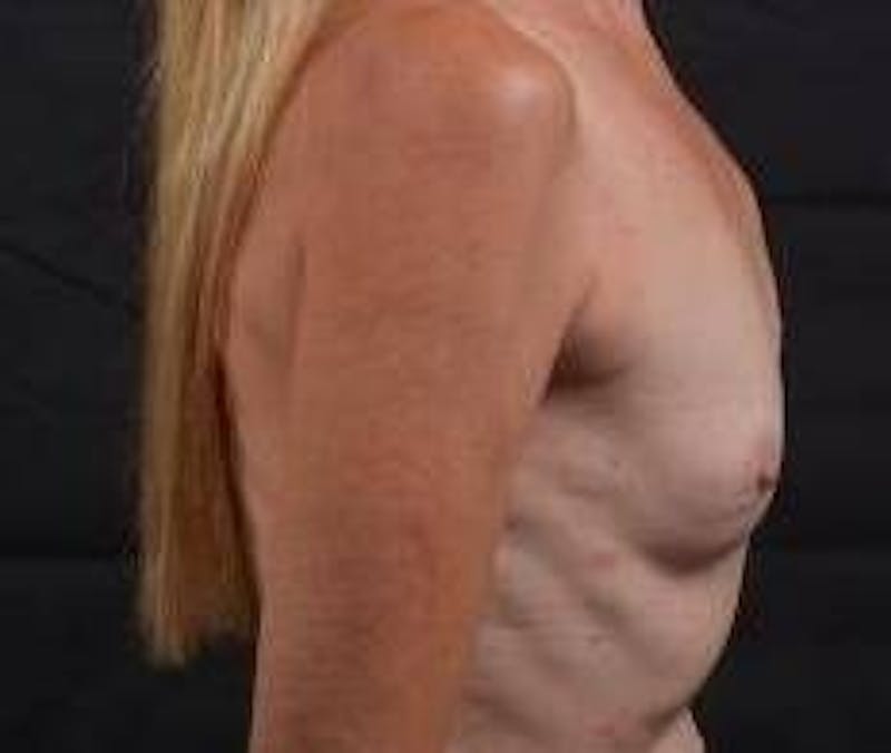 Delayed Breast Reconstruction Before & After Gallery - Patient 320892 - Image 5