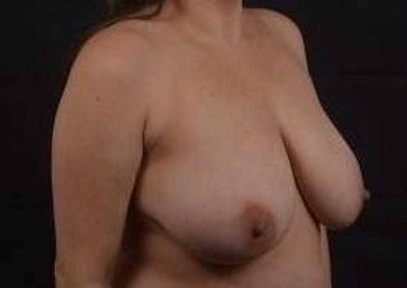 Breast Reduction Before & After Gallery - Patient 228895 - Image 9