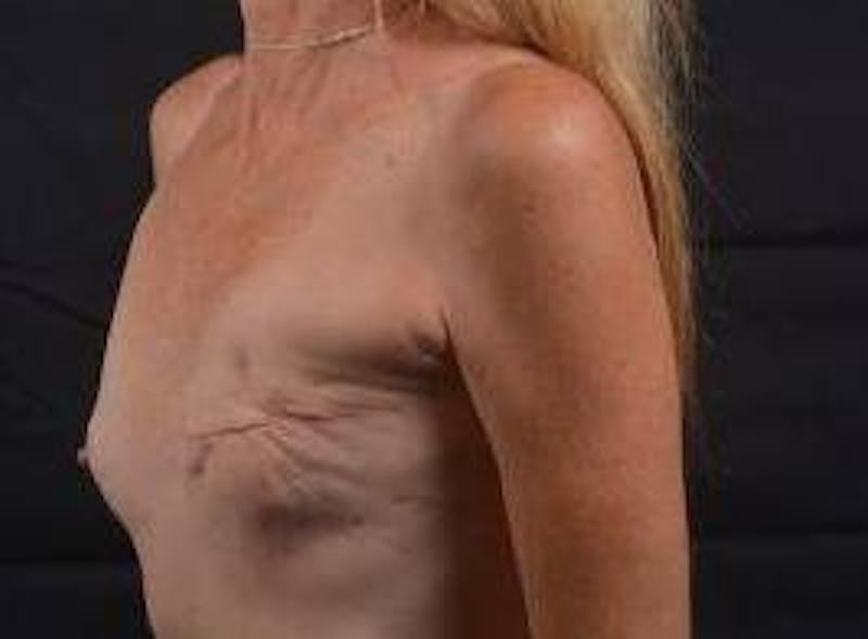 Delayed Breast Reconstruction Before & After Gallery - Patient 320892 - Image 7
