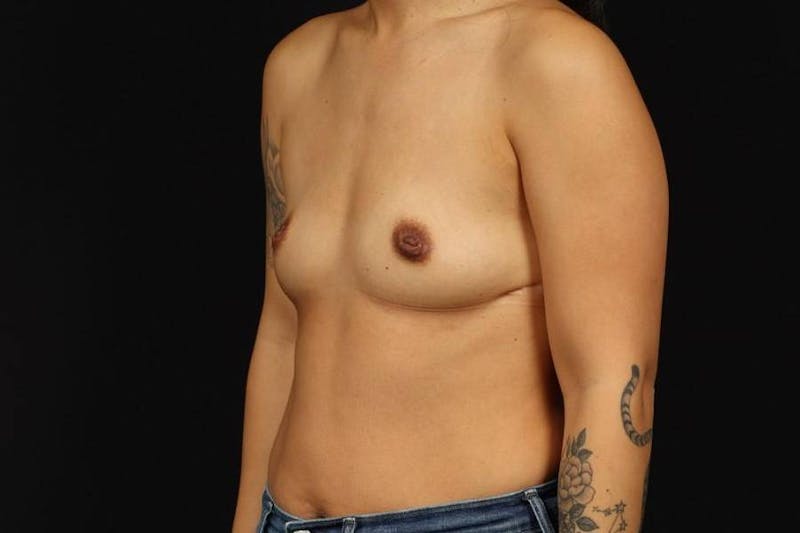 Breast Augmentation Silicone Gel Before & After Gallery - Patient 356162 - Image 3