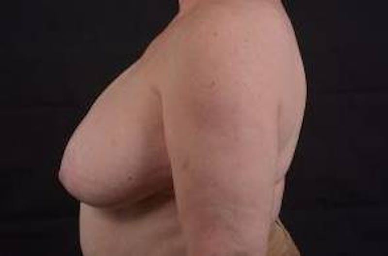 Breast Reduction Before & After Gallery - Patient 761967 - Image 3