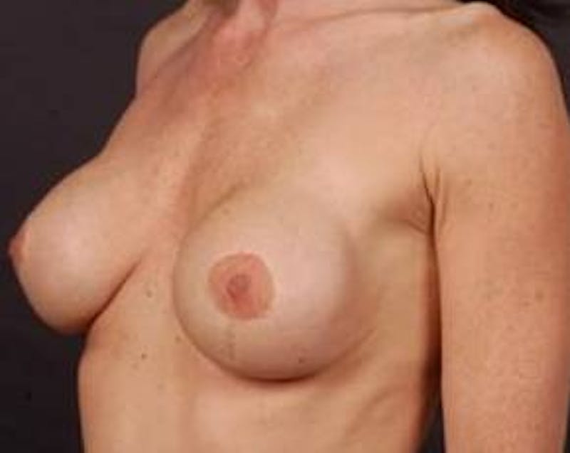 Immediate Breast Reconstruction – Flaps Before & After Gallery - Patient 371009 - Image 3