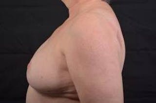 Breast Reduction Before & After Gallery - Patient 761967 - Image 4