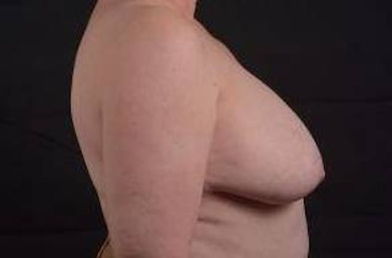 Breast Reduction Before & After Gallery - Patient 761967 - Image 5
