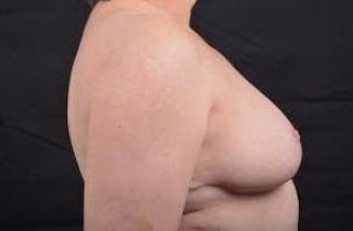 Breast Reduction Before & After Gallery - Patient 761967 - Image 6