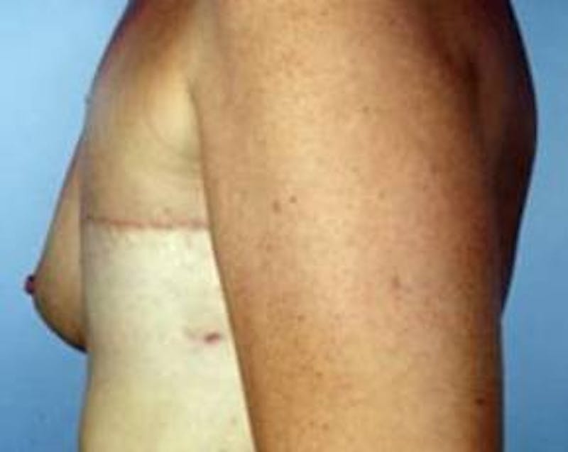 Delayed Breast Reconstruction Before & After Gallery - Patient 327623 - Image 3