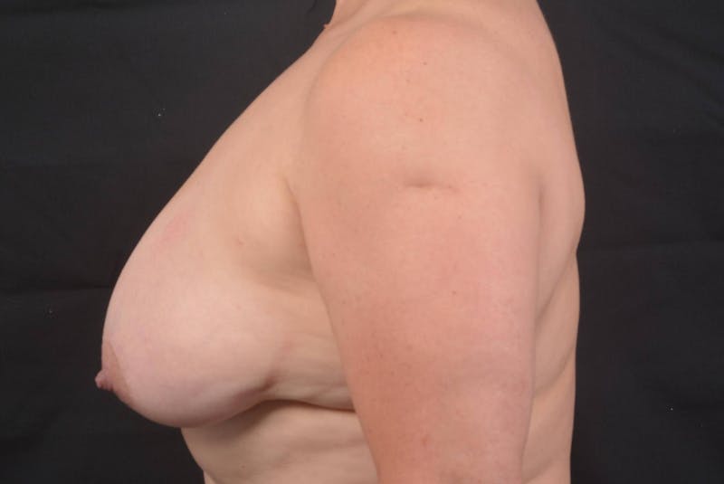 Mastopexy Before & After Gallery - Patient 113720 - Image 3