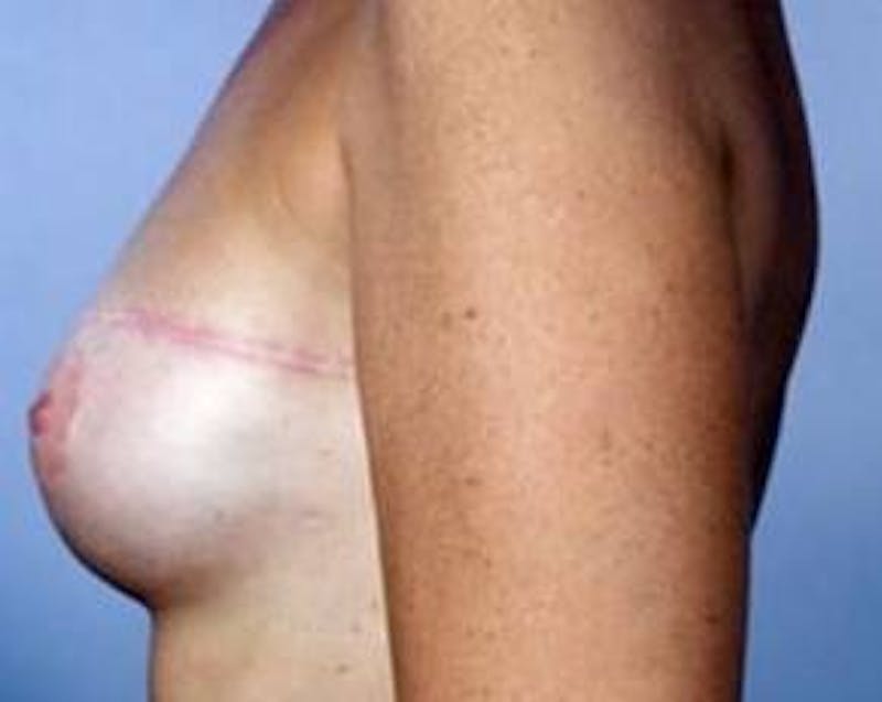 Delayed Breast Reconstruction Before & After Gallery - Patient 327623 - Image 4