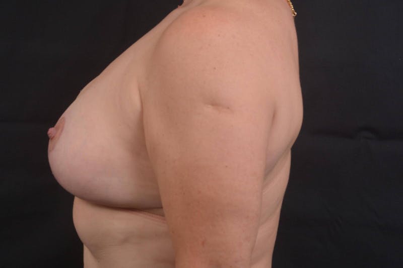 Mastopexy Before & After Gallery - Patient 113720 - Image 4