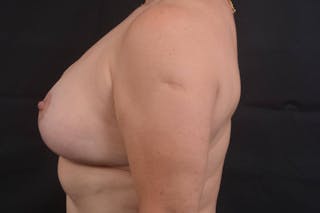 Mastopexy Before & After Gallery - Patient 113720 - Image 4