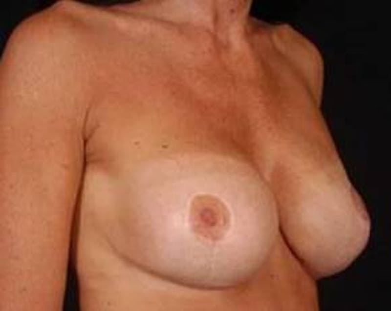 Immediate Breast Reconstruction – Flaps Before & After Gallery - Patient 413156 - Image 6