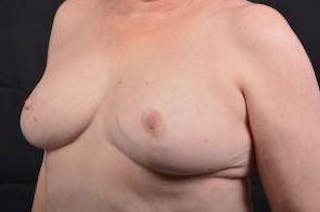 Breast Reduction Before & After Gallery - Patient 761967 - Image 8