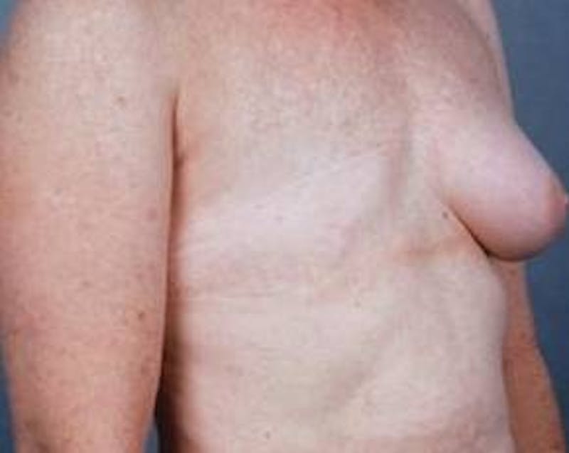 Delayed Breast Reconstruction Before & After Gallery - Patient 139807 - Image 3
