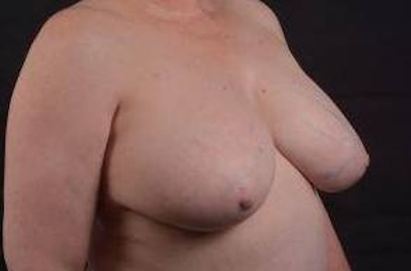 Breast Reduction Before & After Gallery - Patient 761967 - Image 9