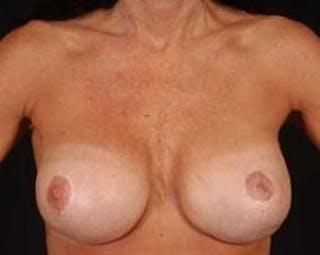Immediate Breast Reconstruction – Flaps Before & After Gallery - Patient 413156 - Image 8