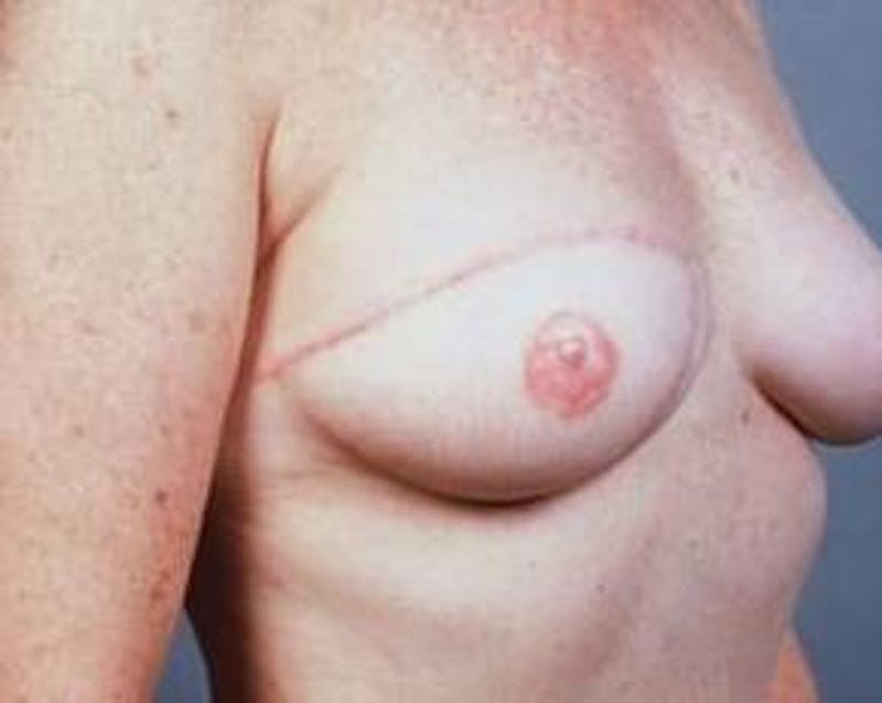 Delayed Breast Reconstruction Before & After Gallery - Patient 139807 - Image 4