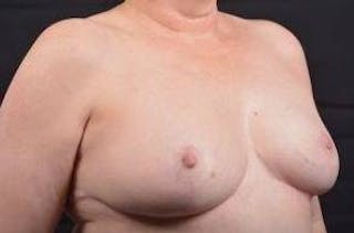 Breast Reduction Before & After Gallery - Patient 761967 - Image 10