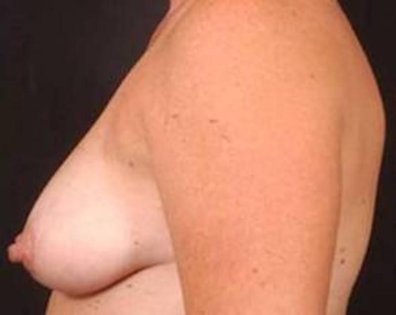 Immediate Breast Reconstruction – Flaps Before & After Gallery - Patient 352908 - Image 3