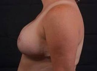 Breast Reduction Before & After Gallery - Patient 399763 - Image 4